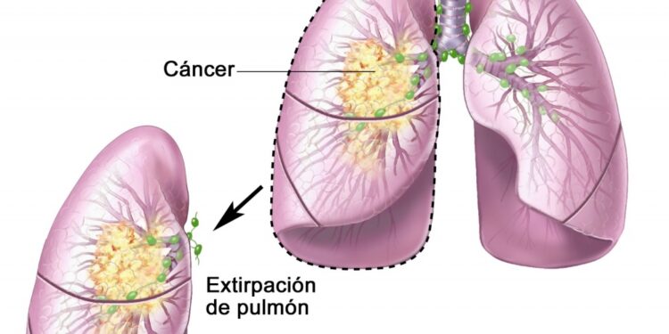 EL DIAGNÓSTICO DEL PAPA LEÓN: Qué es un adenocarcinoma pulmonar: síntomas, causas y tratamientos