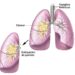 EL DIAGNÓSTICO DEL PAPA LEÓN: Qué es un adenocarcinoma pulmonar: síntomas, causas y tratamientos